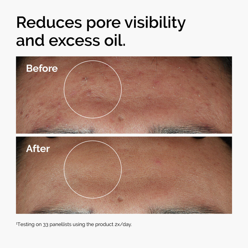 The Ordinary Niacinamide 10% + Zinc 1% before and after pores