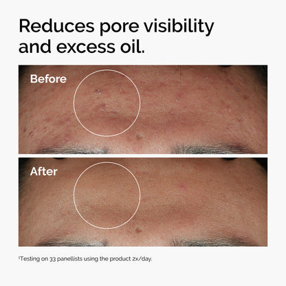 The Ordinary Niacinamide 10% + Zinc 1% before and after pores